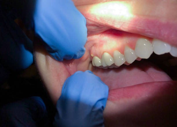 Best Chipped Tooth Repair Near Me  in Park Layne, OH